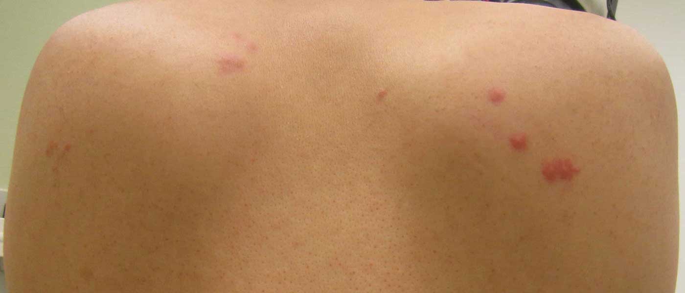 Come Riconoscere Le Cimici Da Letto